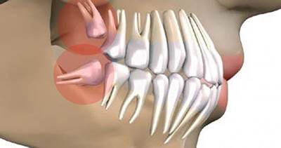 Cosa dovresti sapere sulla rimozione dei denti del giudizio